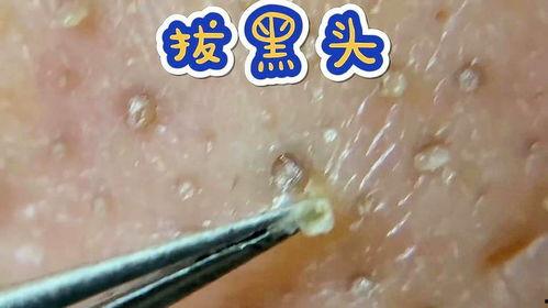 挤粉刺视频,告别痘痘困扰！