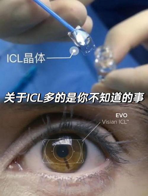 带隐形眼镜的视频,跟随视频揭秘带镜生活