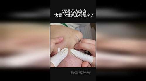 挤脓包视频,视频教学让你告别疼痛