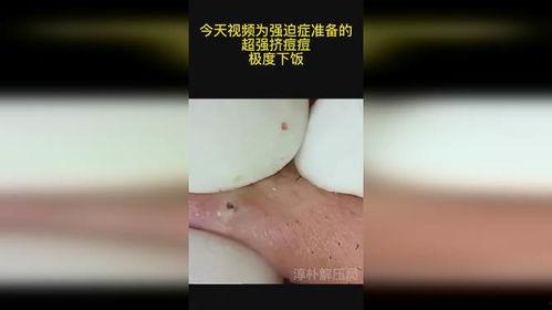 挤脓包视频,视频教学让你告别疼痛