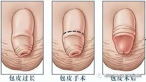 割包皮手术视频,专业视频解析