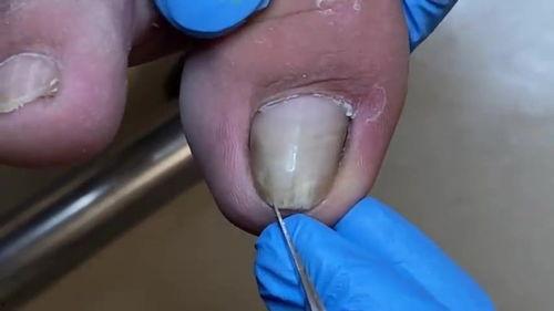 修脚视频手法视频教程,跟随视频教程掌握专业修脚手法