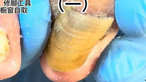 修脚视频手法视频教程,跟随视频教程掌握专业修脚手法