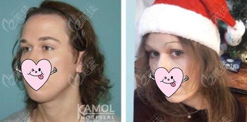 男变女手术视频,医学奇迹与心理挑战并存