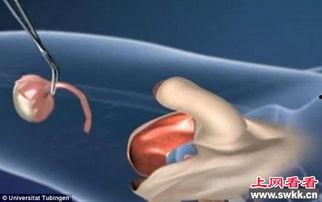 男变女手术视频,医学奇迹与心理挑战并存