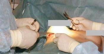 男变女手术视频,医学奇迹与心理挑战并存