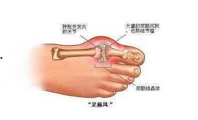 痛风痂人吃黑瓜孑行吗,营养与健康的双重考量