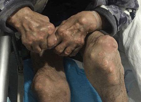 痛风痂人吃黑瓜孑行吗,营养与健康的双重考量